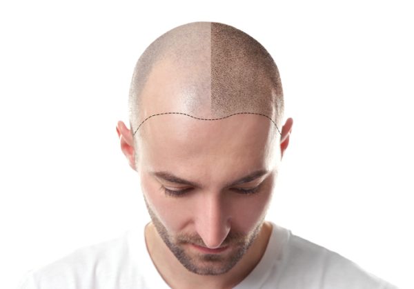 Man before and after hair loss treatment on white background